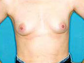 Patient # 47598 Before Photo # 1